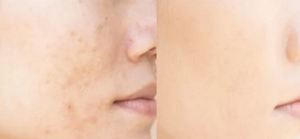 at home chemical peels for acne scars